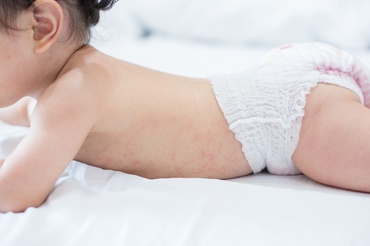 Miliaria sau erupția cutanată provocată de căldură, la bebeluși. Ce reprezintă și cum se poate trata